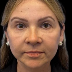 Facelift Before & After Patient #3407