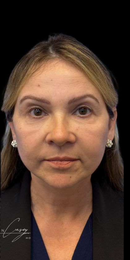 Facelift Before & After Patient #3407