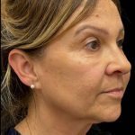 Facelift Before & After Patient #3407