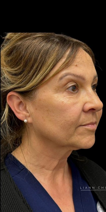 Facelift Before & After Patient #3407