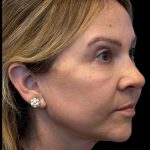 Facelift Before & After Patient #3407
