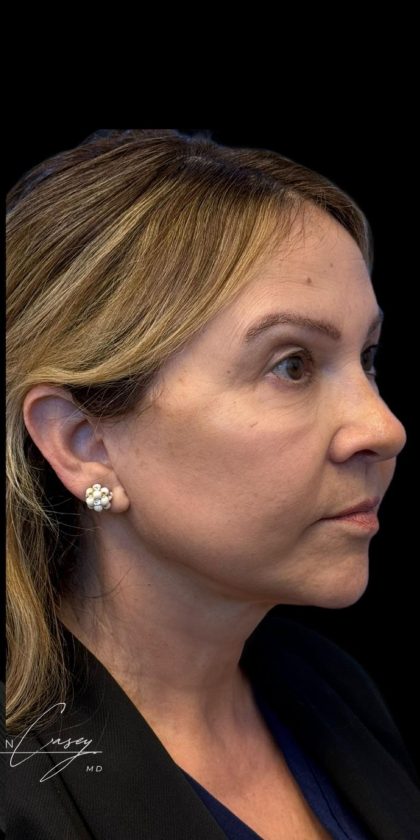 Facelift Before & After Patient #3407