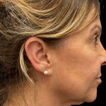 Facelift Before & After Patient #3407