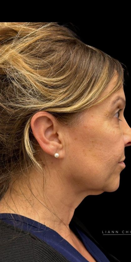 Facelift Before & After Patient #3407