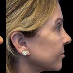 Facelift Before & After Patient #3407