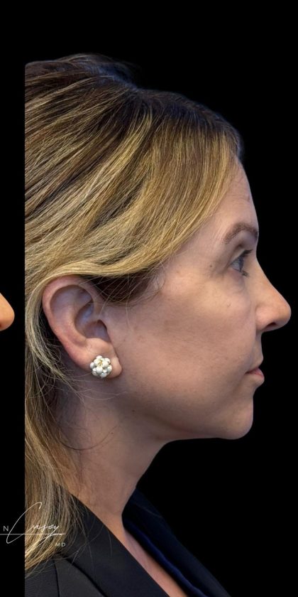 Facelift Before & After Patient #3407