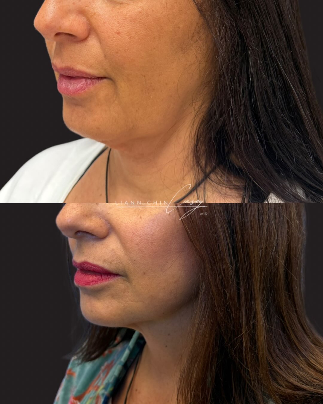 Before and After
