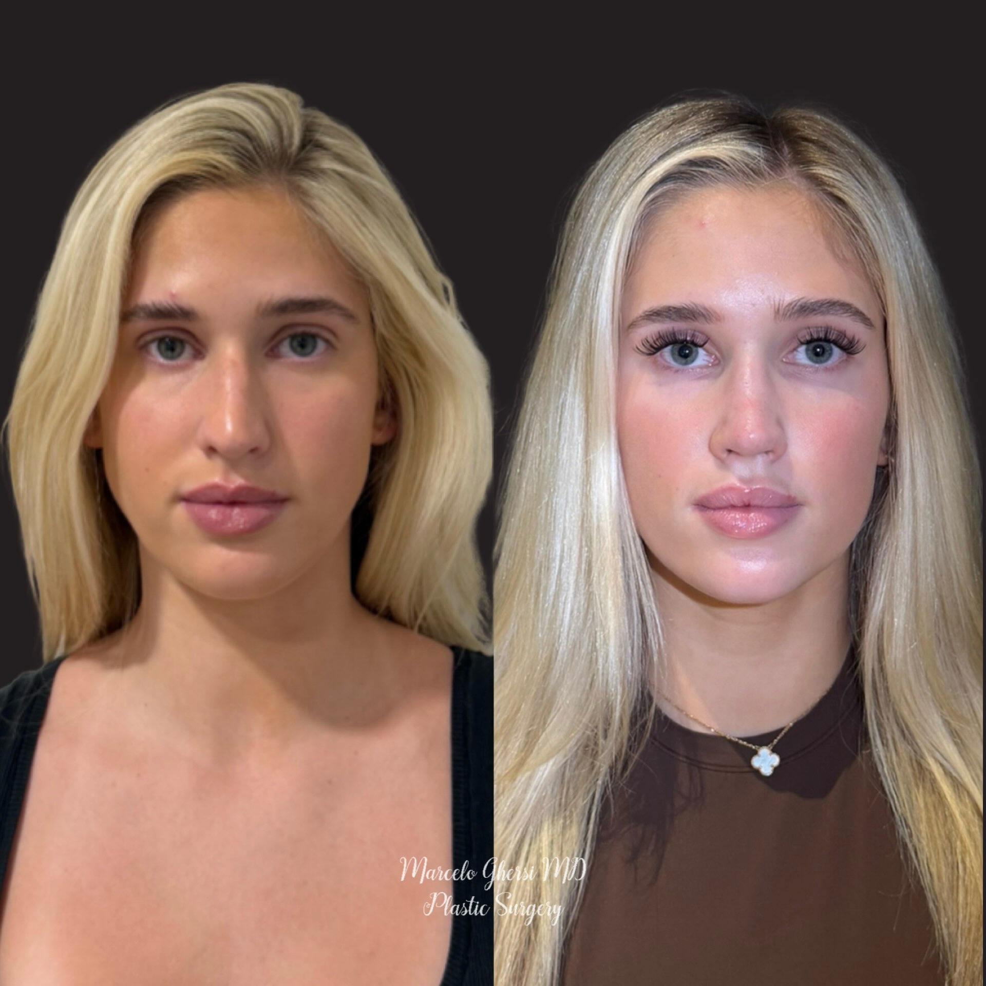 Before and After