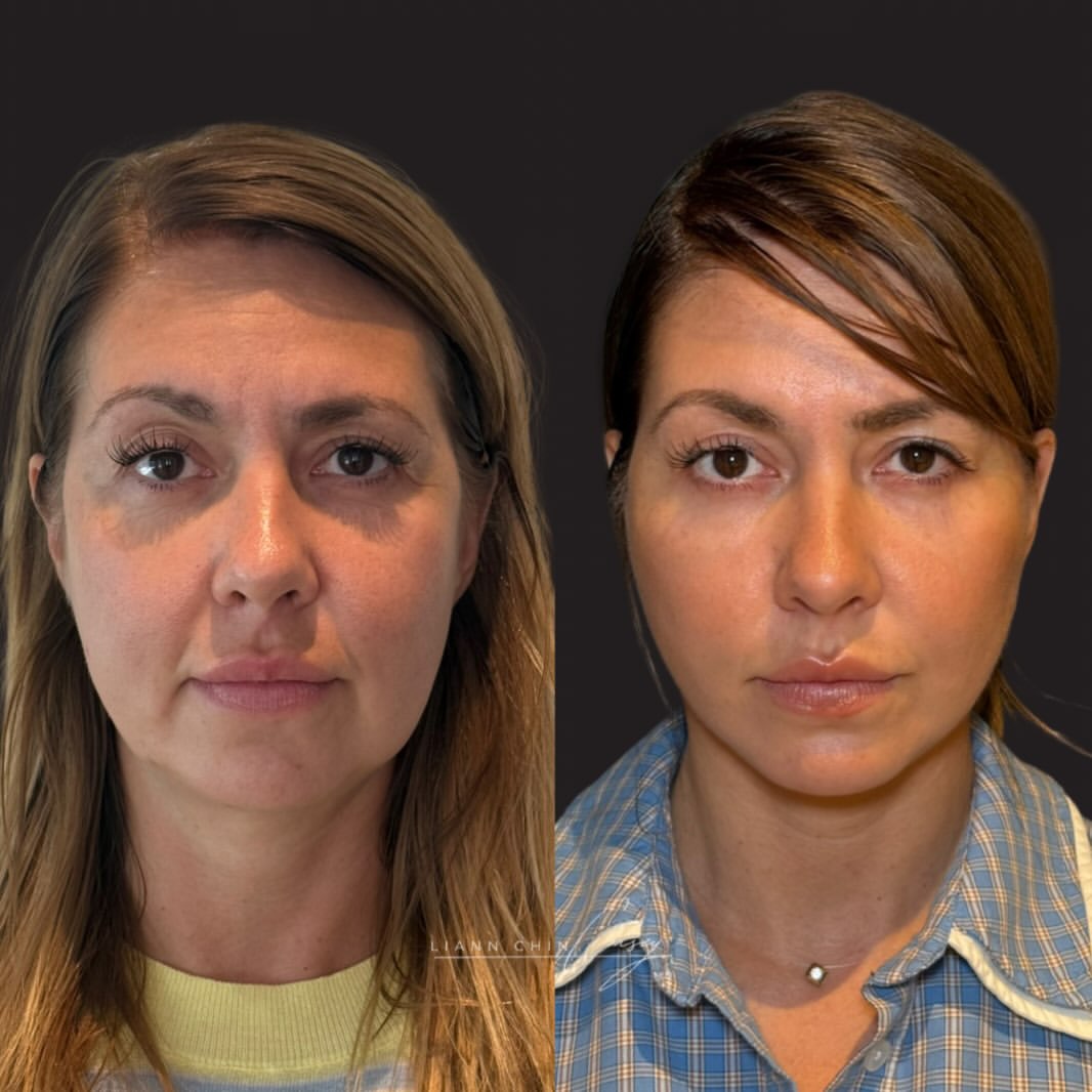 Before and After