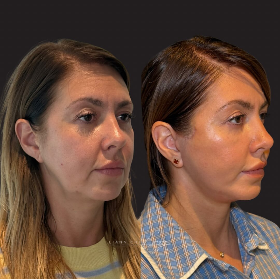 Before and After