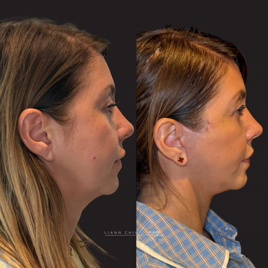 Before and After