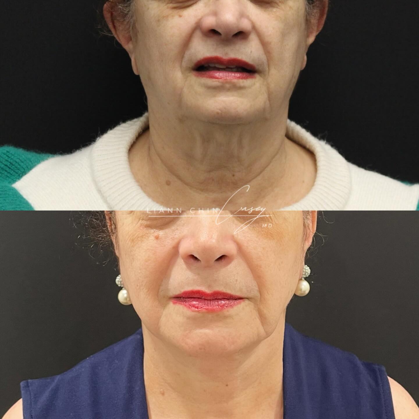 Before and After