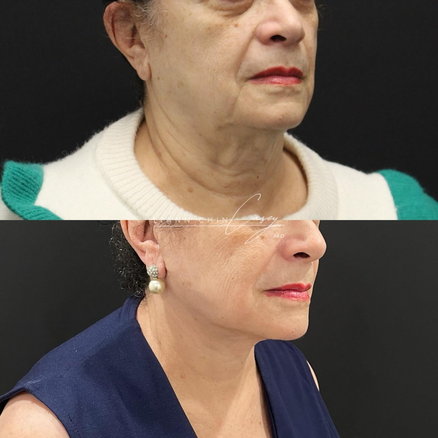 Before and After