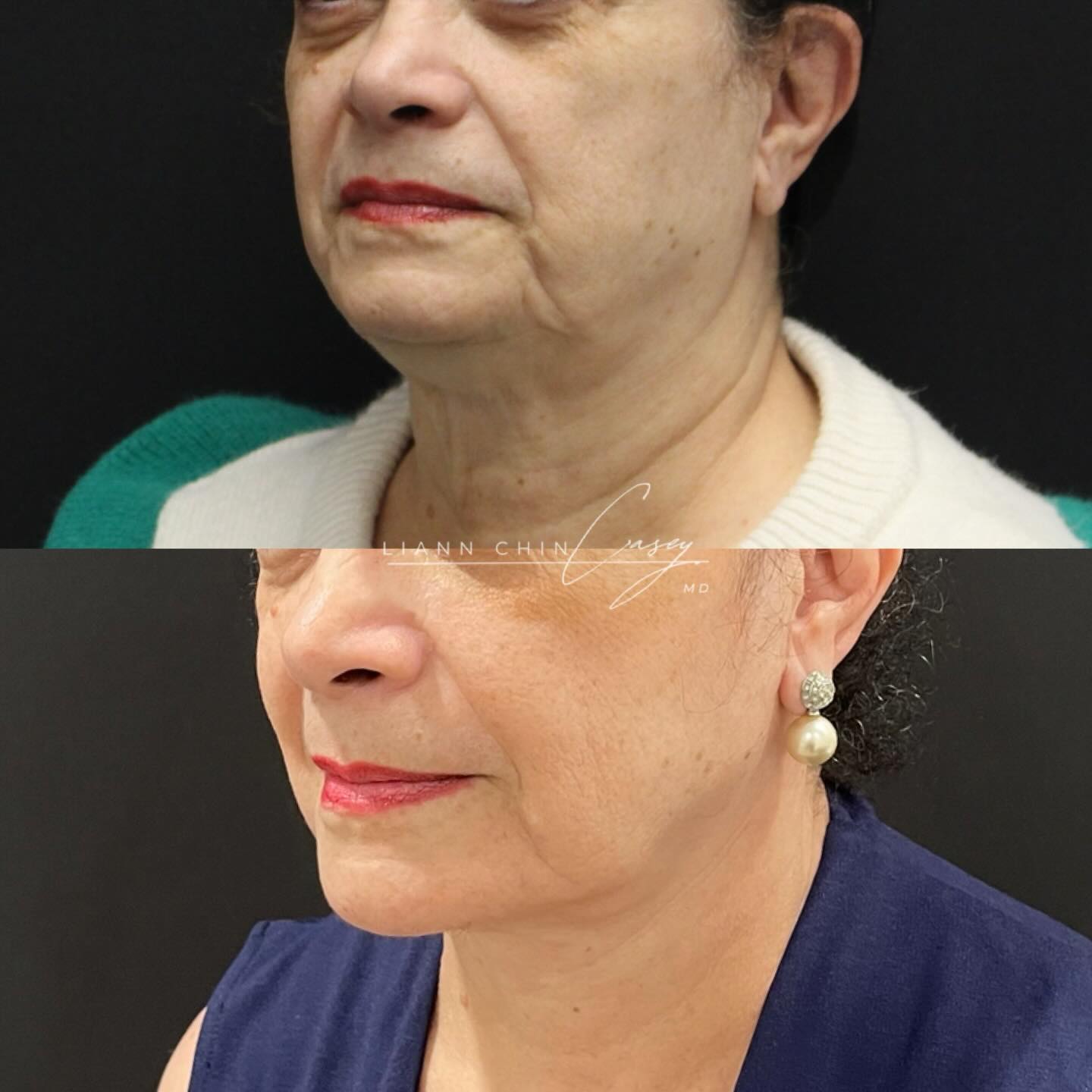 Before and After