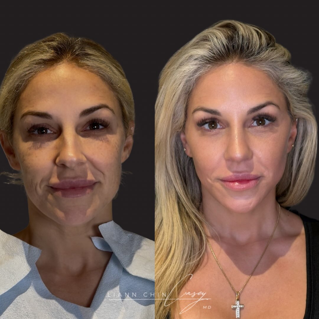 Before and After