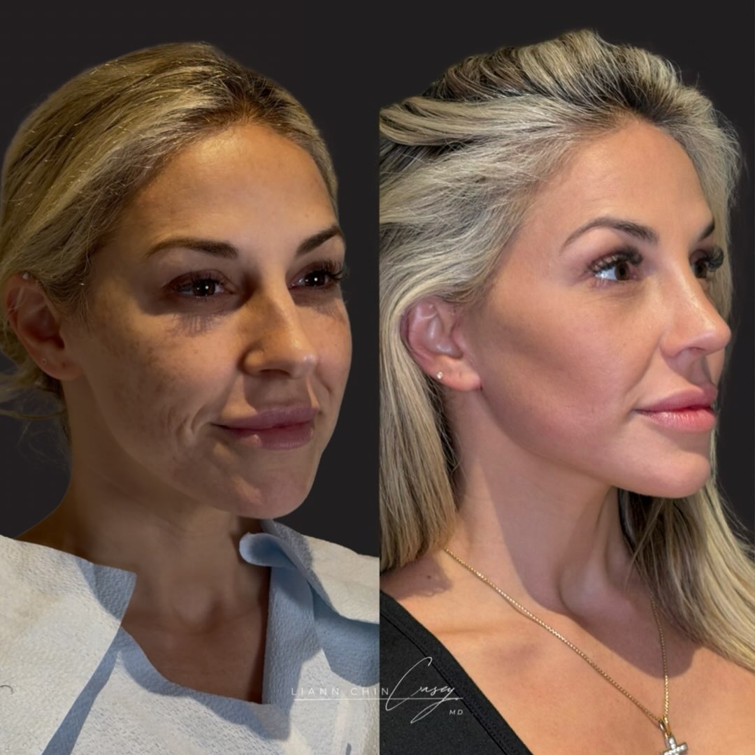 Before and After