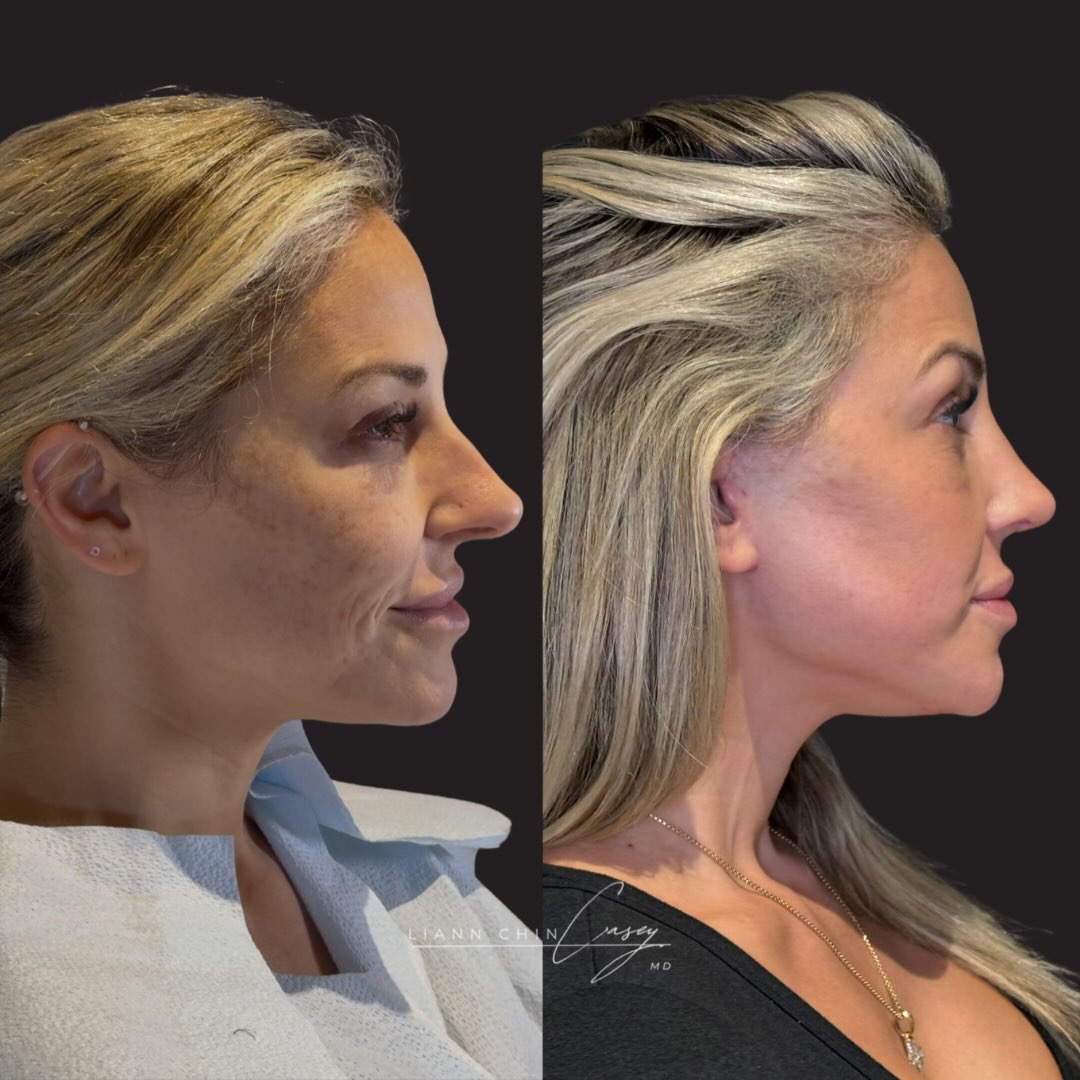 Before and After