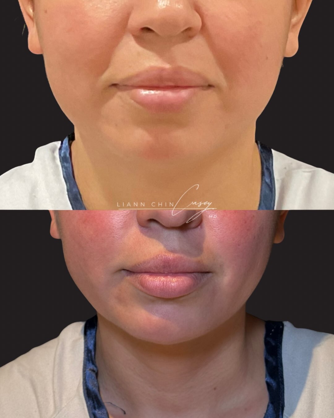 Before and After