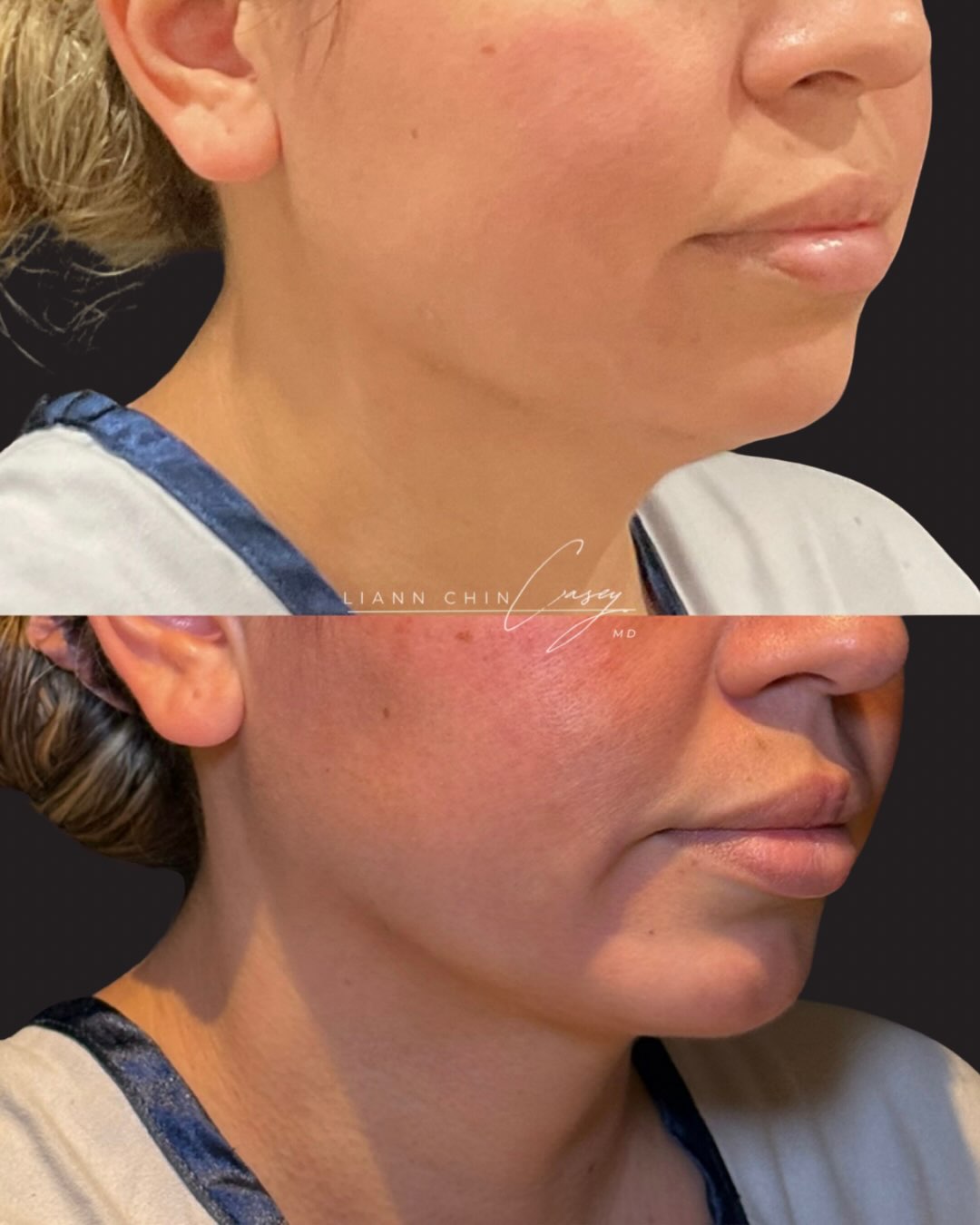 Before and After
