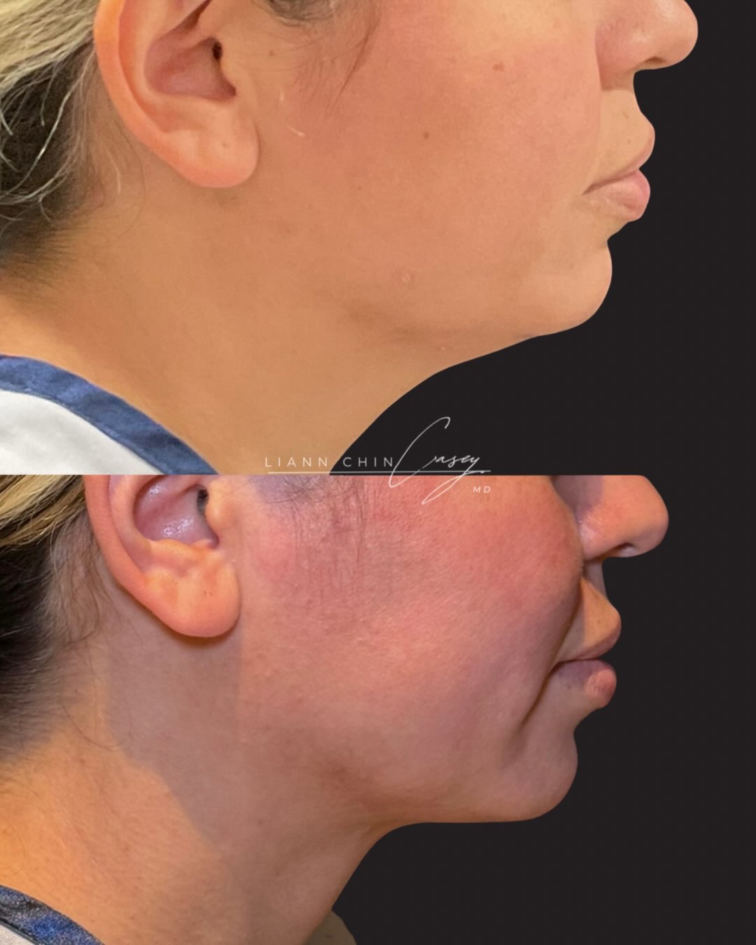 Before and After